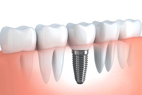 Dental Implants