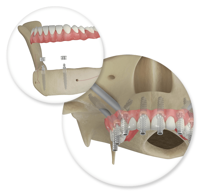 Dental Implants to replace teeth