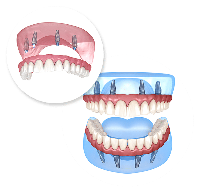 Dental Implants in Las Vegas