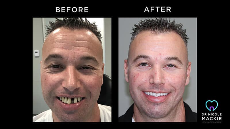 Doctor Nicole Mackie Dental Implant Specialty Center Before And After Patient