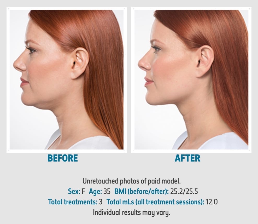 Kybella Before and After