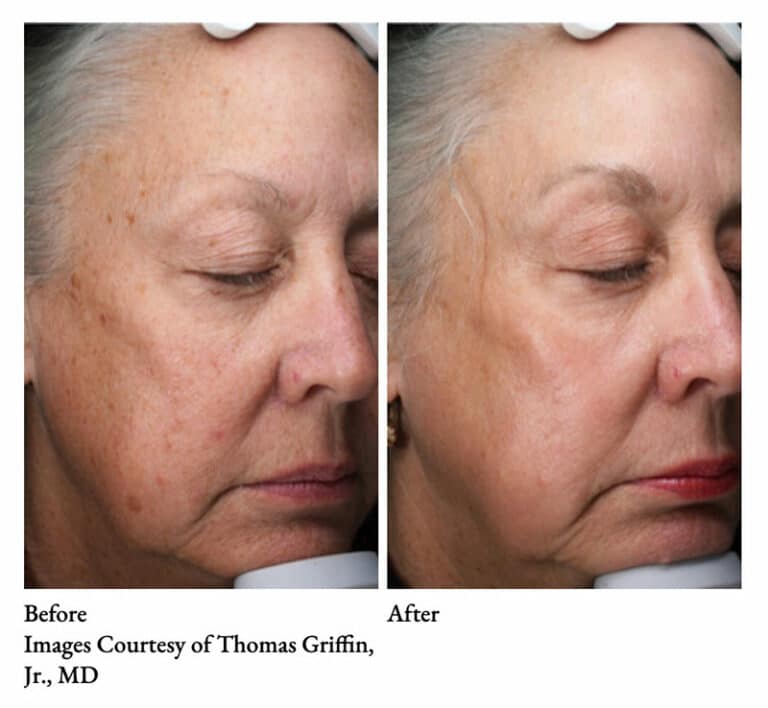 Subnovii Plasma Skin Resurfacing