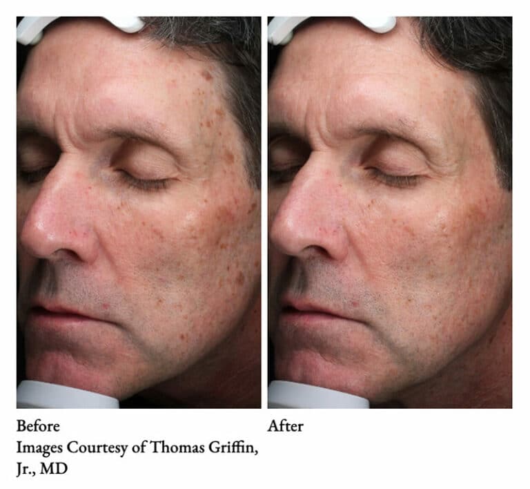 Subnovii Plasma Skin Resurfacing