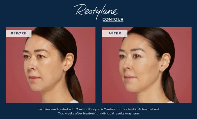 Restylane Countour before and after