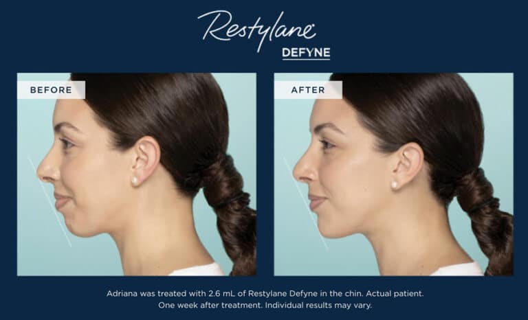 Restylane Defyne before and after
