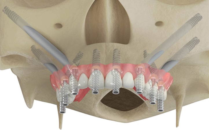 Zygomatic Dental Implants Las Vegas