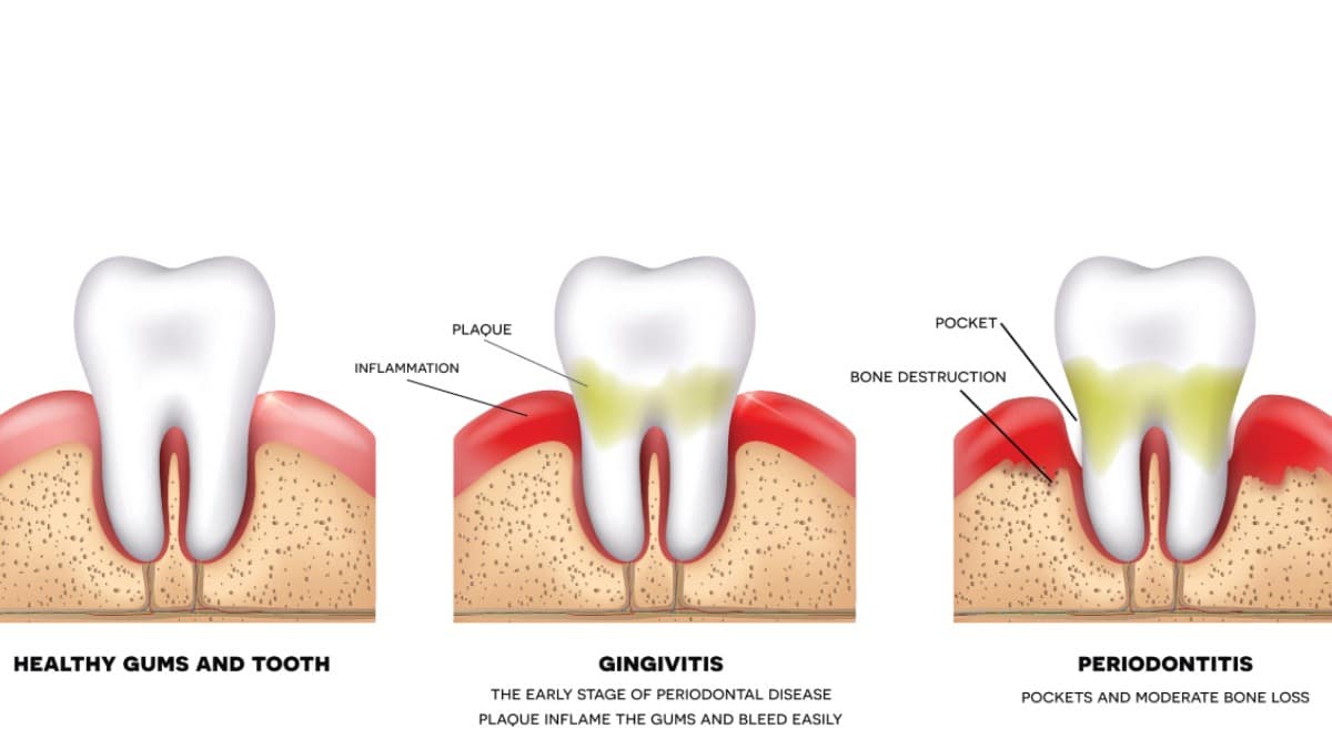 Dentists Say These 6 Tips Help Stop Bleeding Gums Naturally Dr