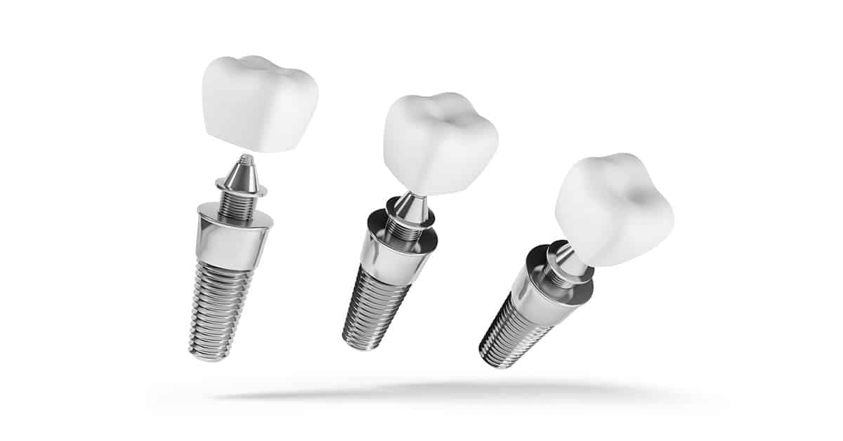 3 on 6 Dental Implant Procedure