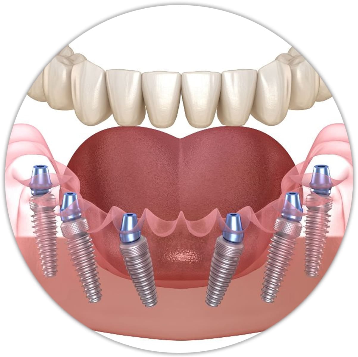 3 on 6 Dental Implant Procedure